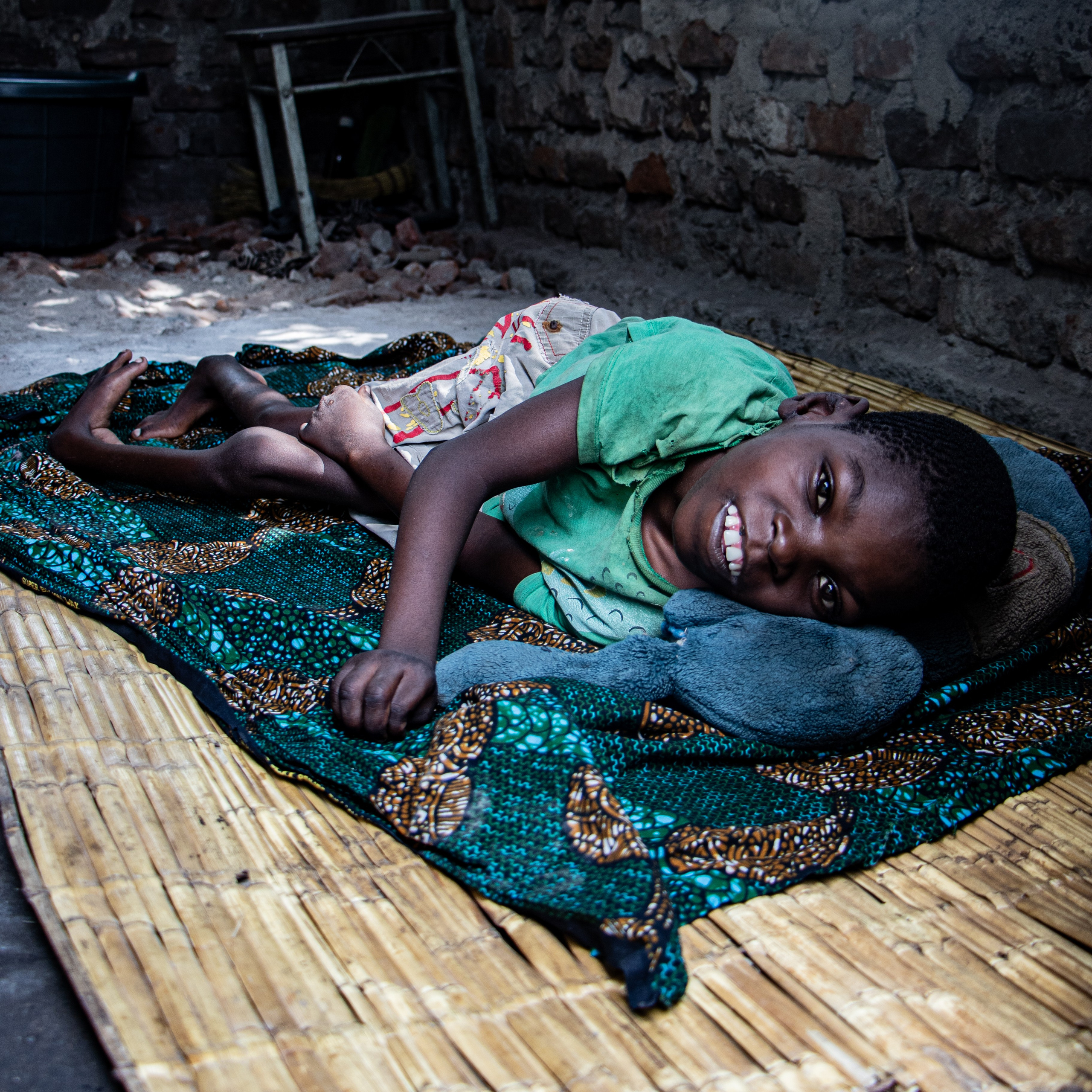 Francisco, 14 ans. Autour de la mine de Moatize, dans la province de Tete, de plus en plus de familles témoignent de la naissance d’enfants atteints de malformations congénitales. Bien qu’aucune étude officielle indépendante n’ait encore été menée à grande échelle, les habitants pointent du doigt la pollution constante liée à l’extraction du charbon : poussières fines, métaux lourds, rejets chimiques dans l’eau et l’air. Certaines familles affirment que des cas d’anomalies à la naissance sont devenus plus fréquents depuis l’arrivée des activités minières industrielles, d’abord sous Vale, puis sous Vulcan.