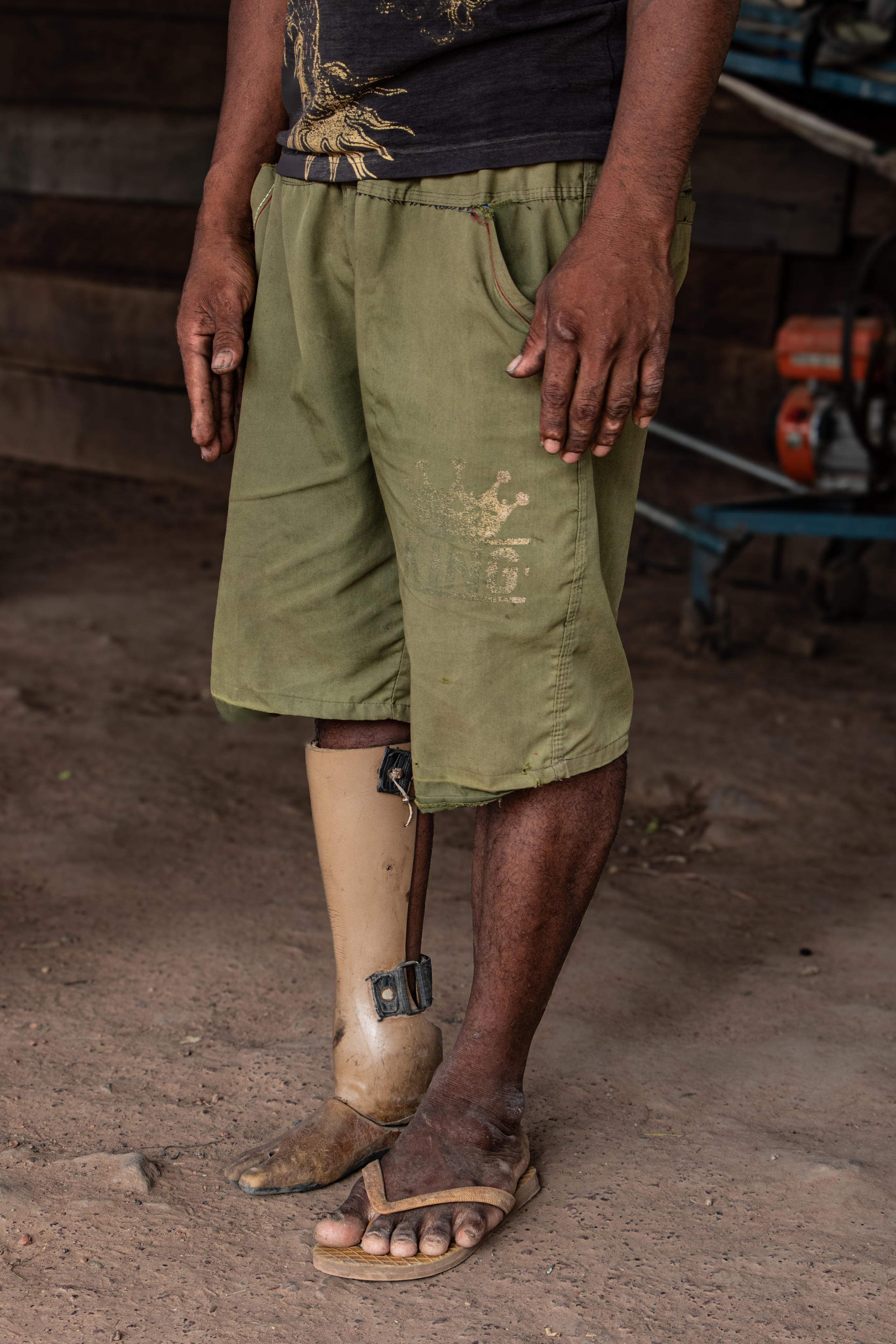 Nga Mao porte sa prothèse qui sera ensuite ajustée et réparée. 
