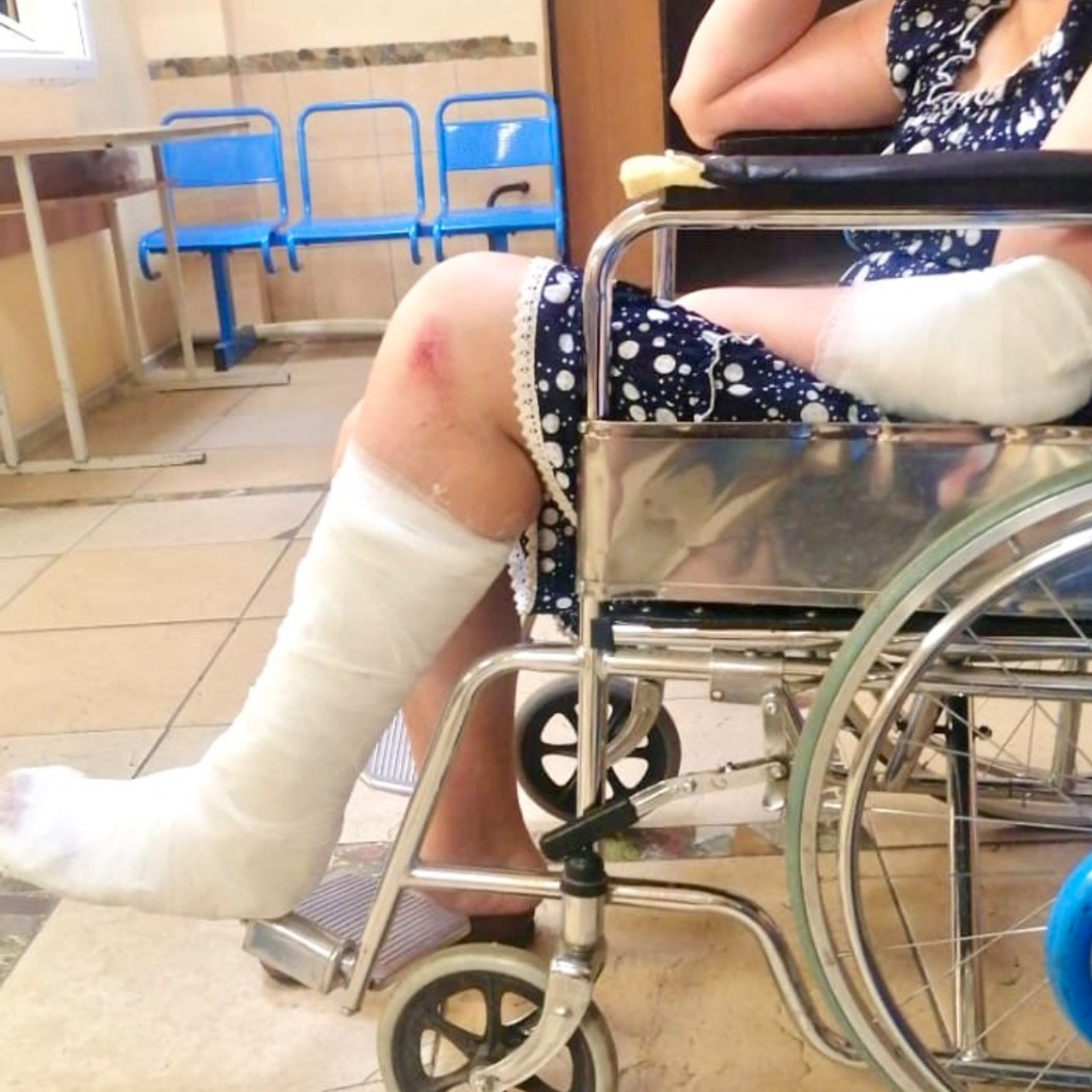 У Натальи смещенный перелом